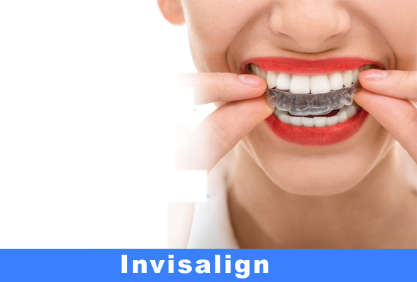 Invisalign